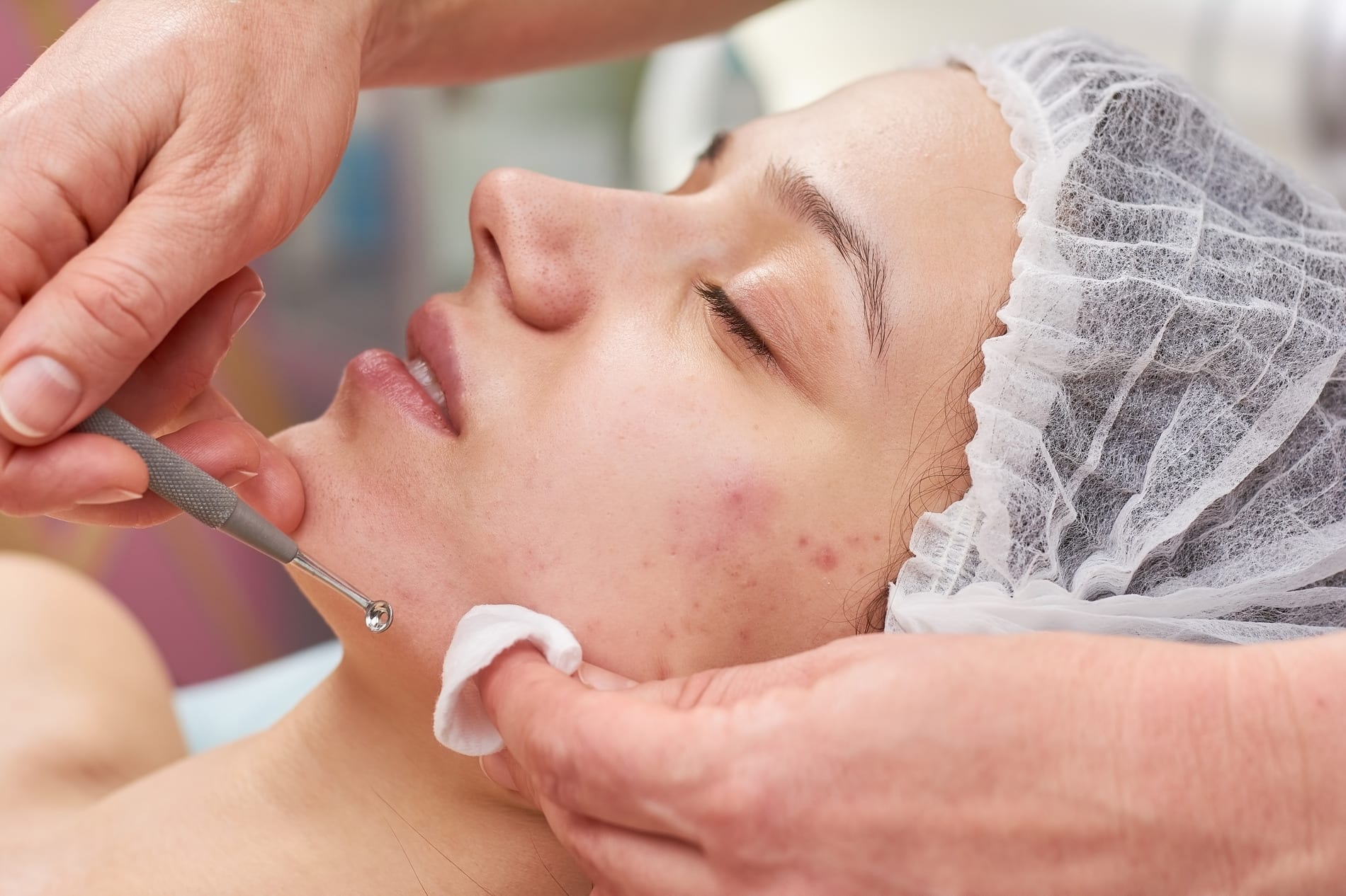 Woman recieving treatment for her acne at Rocklin Dermatology