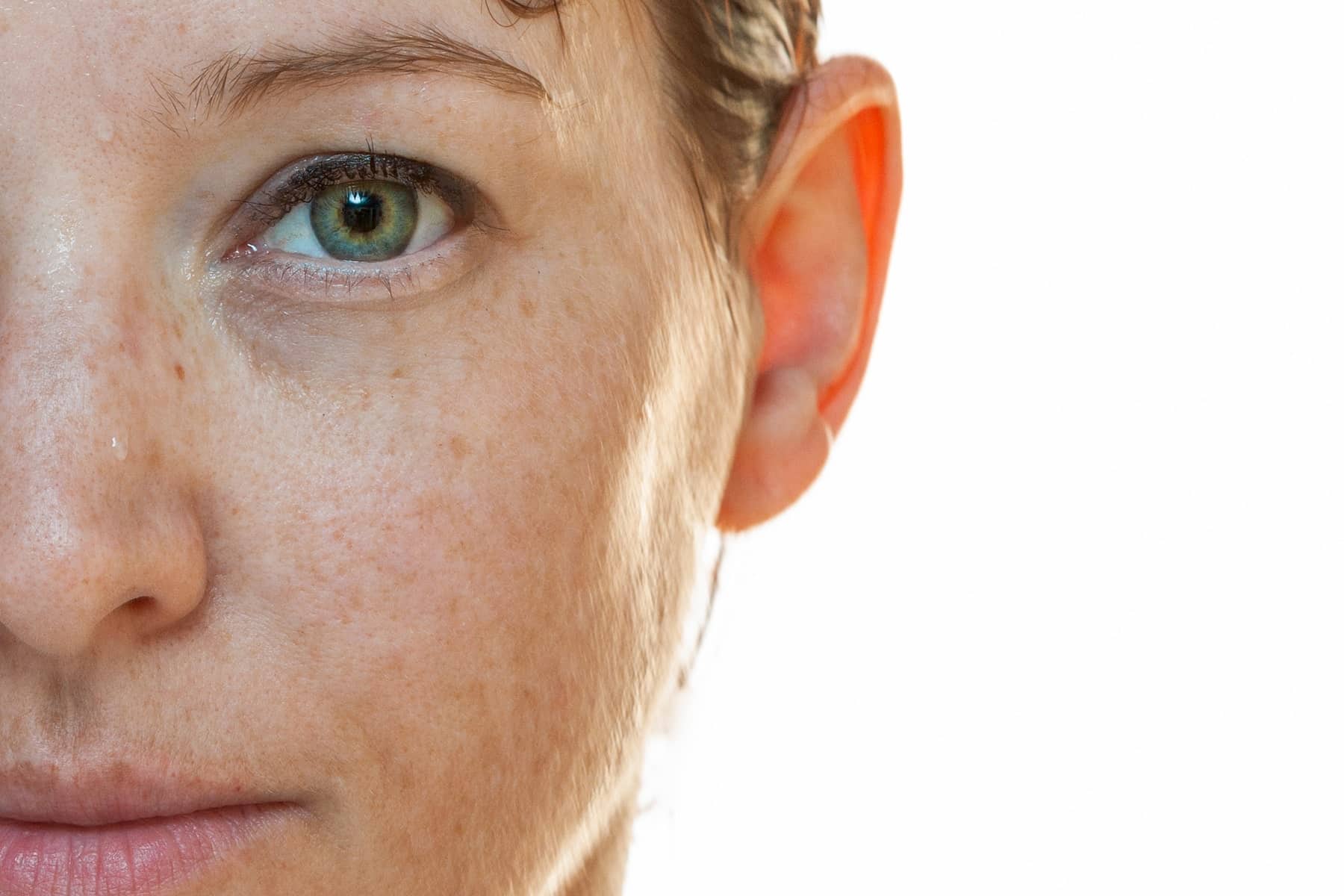 Sun spot treatment dermatologist in Rocklin, CA 