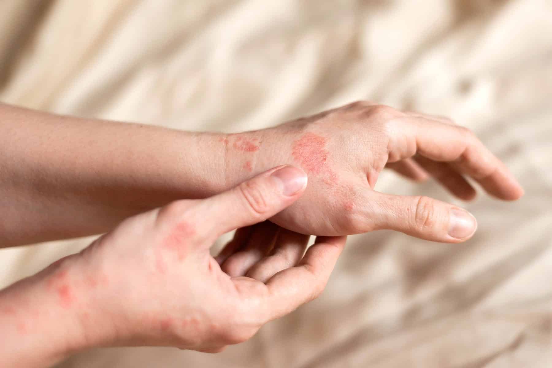 Psoriasis doctor in Rocklin, CA